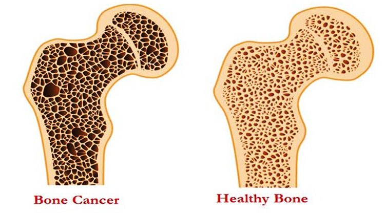 "วัยรุ่น" ผู้มีอายุ 10-20 ปี วัยทำงาน อายุต่ำกว่า 35 ปี  เสี่ยง "โรคมะเร็งกระดูก" ระยะสุดท้ายเจ็บปวดสุดทรมาน