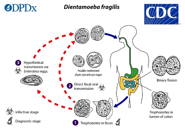 ไม่ต้องกินผัดไท ก็ติดได้  Barnes และ Prigg อ้างชีวิตพัง เพราะติดเชื้อ Dientamoeba Fragilis จากไทย