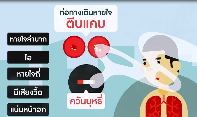 แพทย์จุฬา ฯ วิจัย ความเข้าใจที่ไม่ถูกต้อง ควันบุหรี่ ทำให้เกิดโรคถุงลมโป่งพองเท่านั้น แต่ยังเป็นปัจจัยเสี่ยง