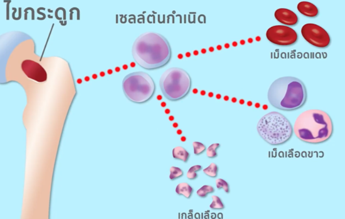 แพทย์ชี้ โรคไขกระดูกบกพร่อง กรณีไม่รุนแรง อยู่ได้เกิน 6 ปี รักษาแบบประคับประคอง แต่หากโรคกลายเป็นมะเร็งเม็ดเลือดขาวเฉียบพลัน อยู่ได้ 5 เดือน