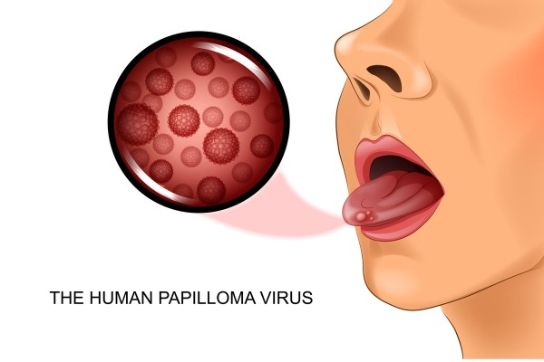 ข้อดีของ วัคซีนมะเร็งปากมดลูก ป้องกันเชื้อไวรัส HPV ที่อาจก่อโรคบริเวณอวัยวะเพศ และทวารหนักจนลุกลาม รักษาไม่หาย