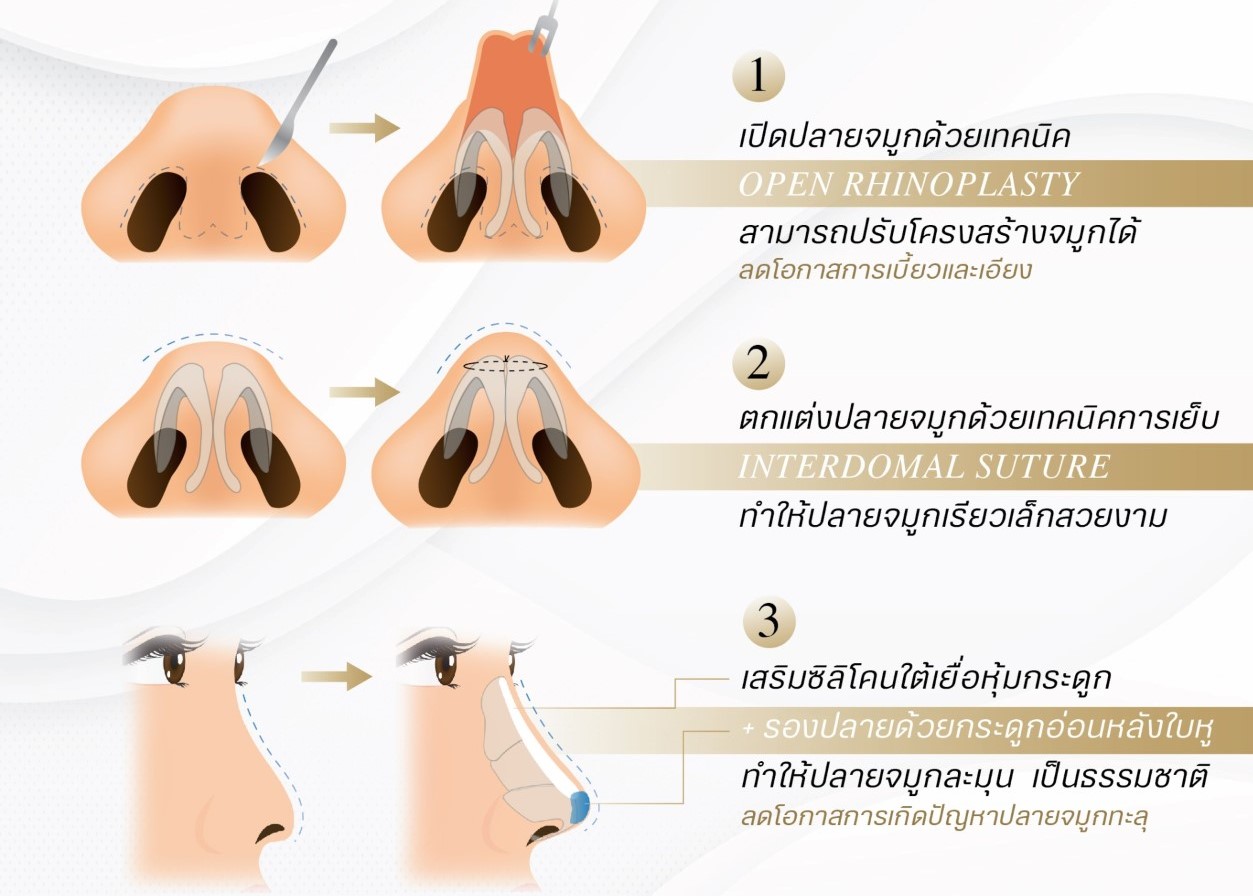 ศูนย์ศัลยกรรมความงามโรงพยาบาลบางมด  ผุดเทคนิคเสริมจมูกใหม่  “HYBRID OPEN RHINOPLASTY”  ขั้นกว่าของการเสริมจมูก