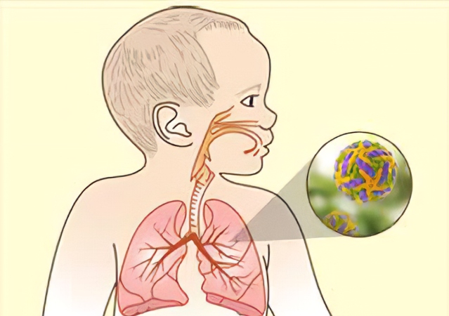 RSV หรือชื่อเต็มว่า Respiratory Syncytial Virus เป็นเชื้อที่ก่อให้เกิดโรคในทางเดินหายใจ โดยเฉพาะเด็กเล็ก